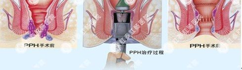PPH手术过程示意图