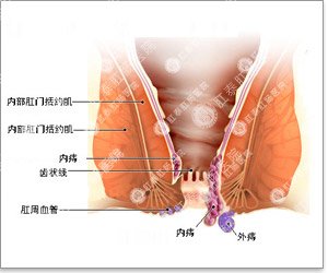 外痔疮的不错治疗方法？