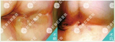 HCPT方法治疗肛周脓肿对比图