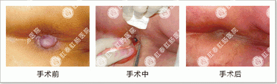 血栓性外痔剥离摘除术