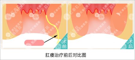 泉州哪家医院治疗肛瘘不错？