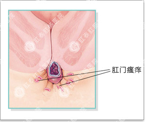 肛门瘙痒的症状表现有哪些？