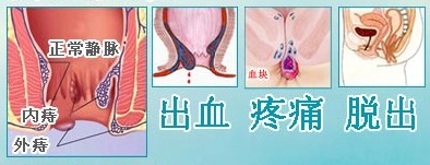 痔疮早期会出现什么症状